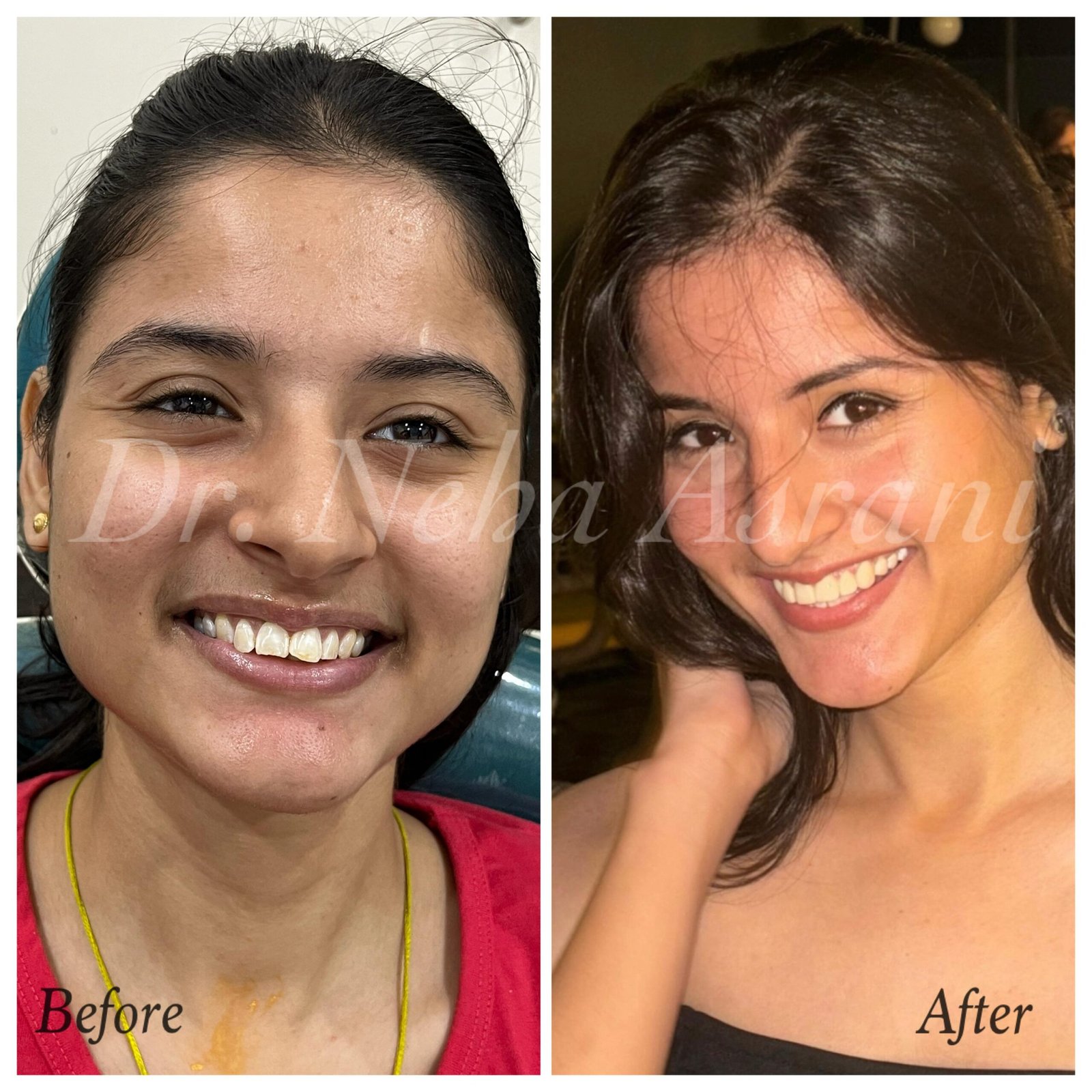 Before and after: Smile makeover with veneers