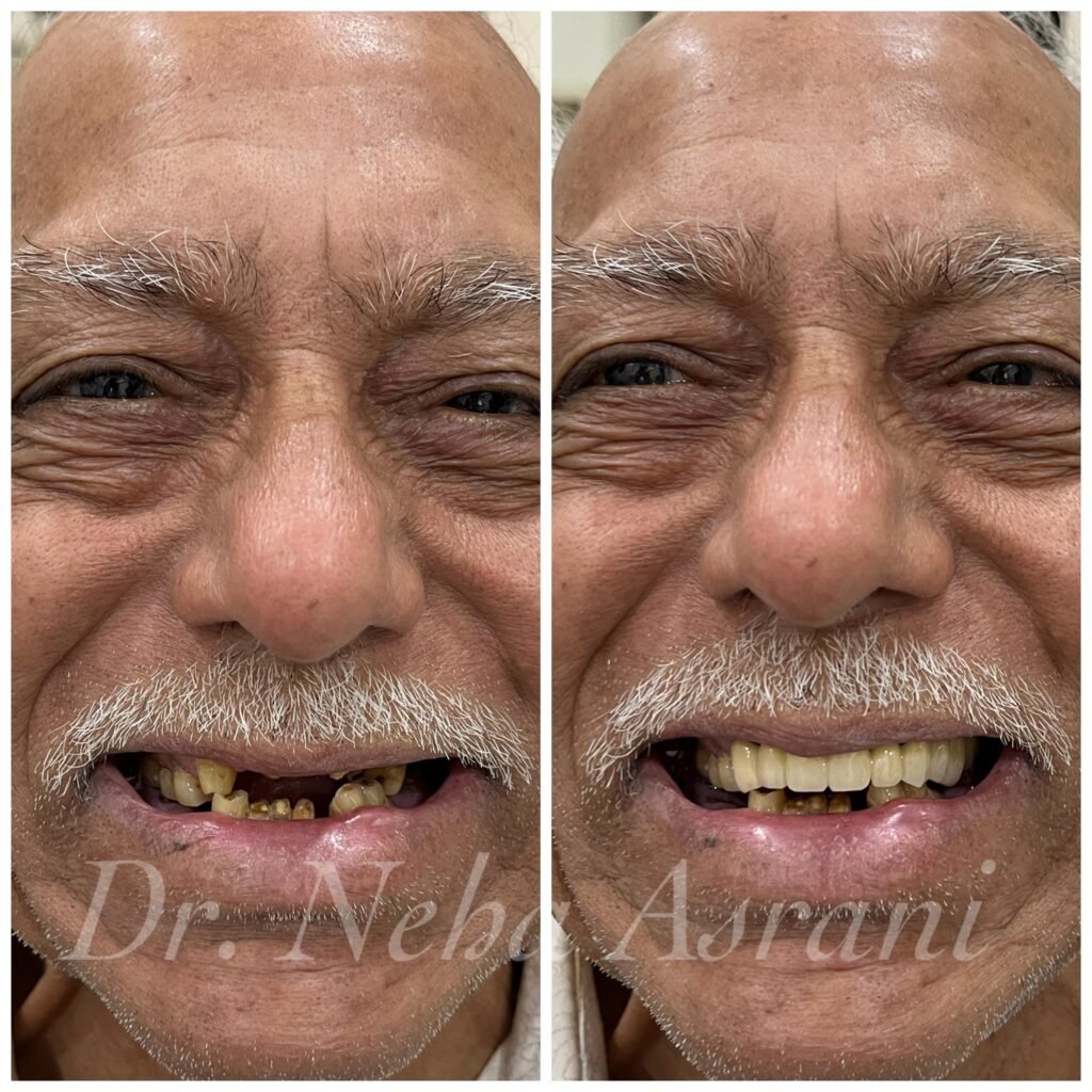 Before and after: Crowns and bridge restoration