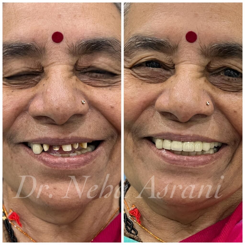 Before and after: Replacement of broken teeth