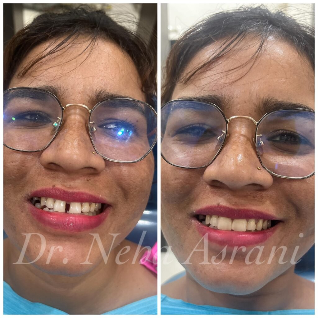 Before and after: Crooked teeth correction