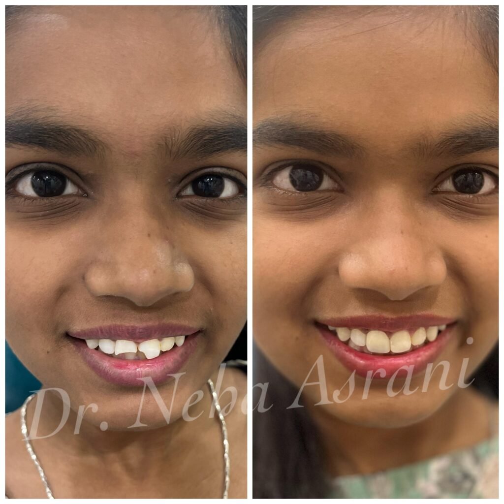 Before and after: Smile makeover with aligners