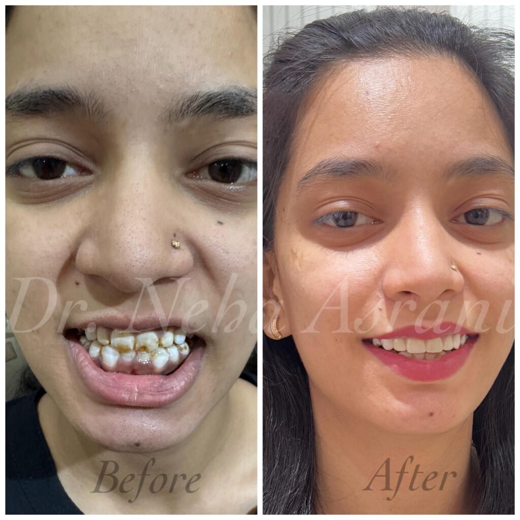 Before and after: Complete smile transformation