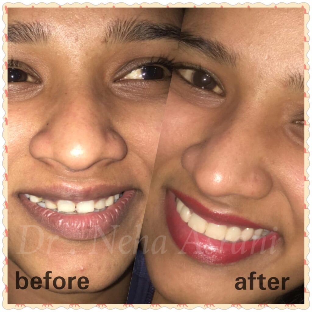 Before and after: Cosmetic smile correction