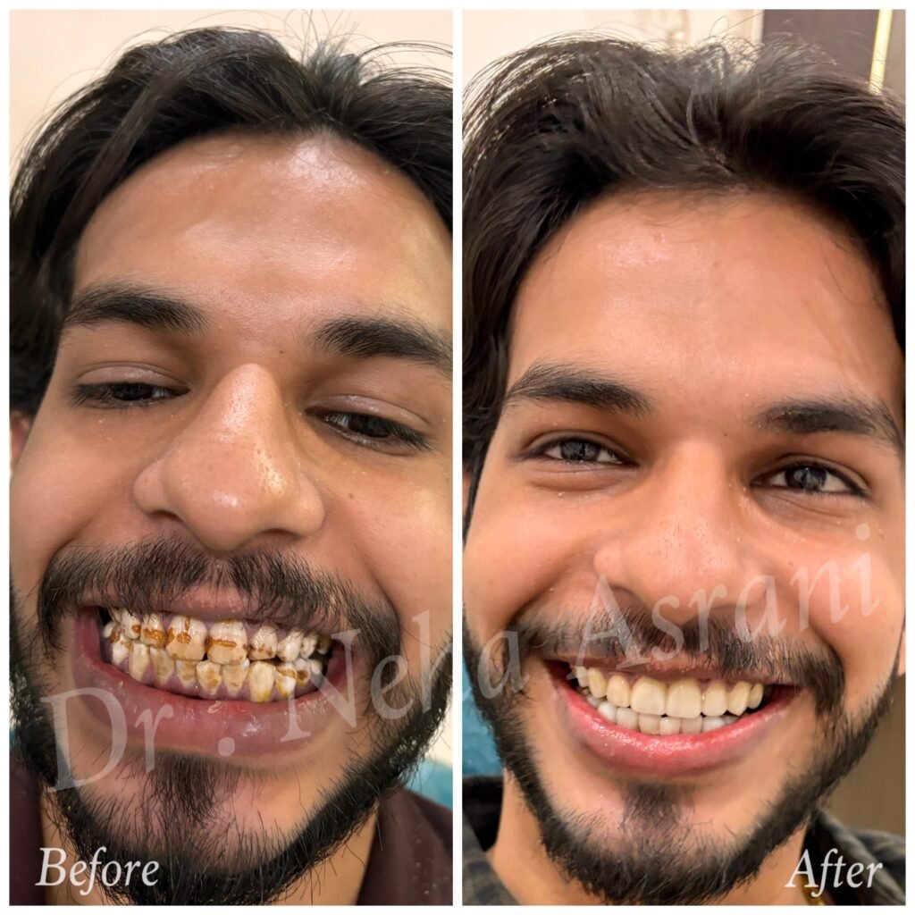 Before and after: Discoloured teeth corrected