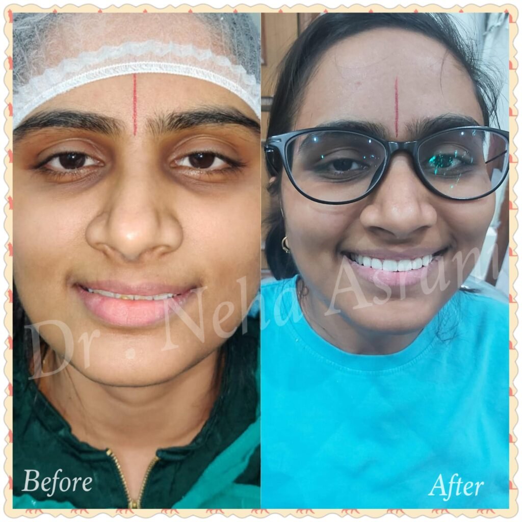 Before and after: Missing teeth replacement