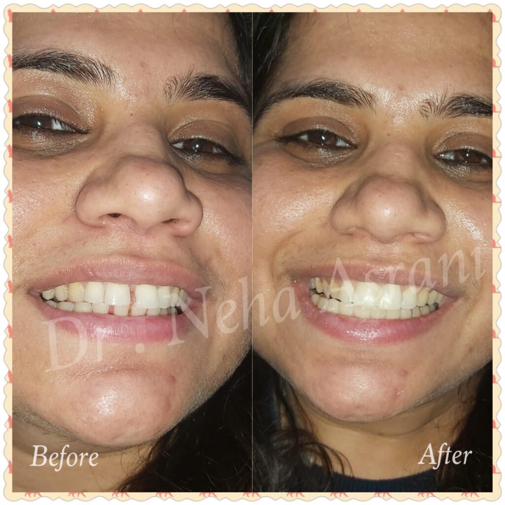 Before and after: Veneers and whitening
