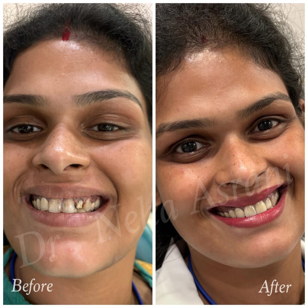 Before and after: Spacing and alignment correction