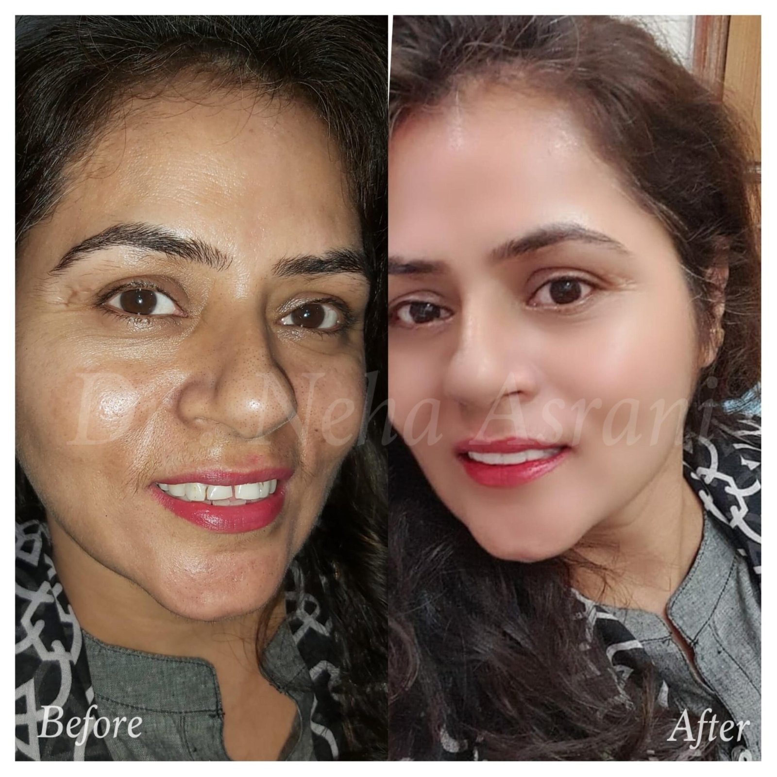 Before and after: Complete smile transformation