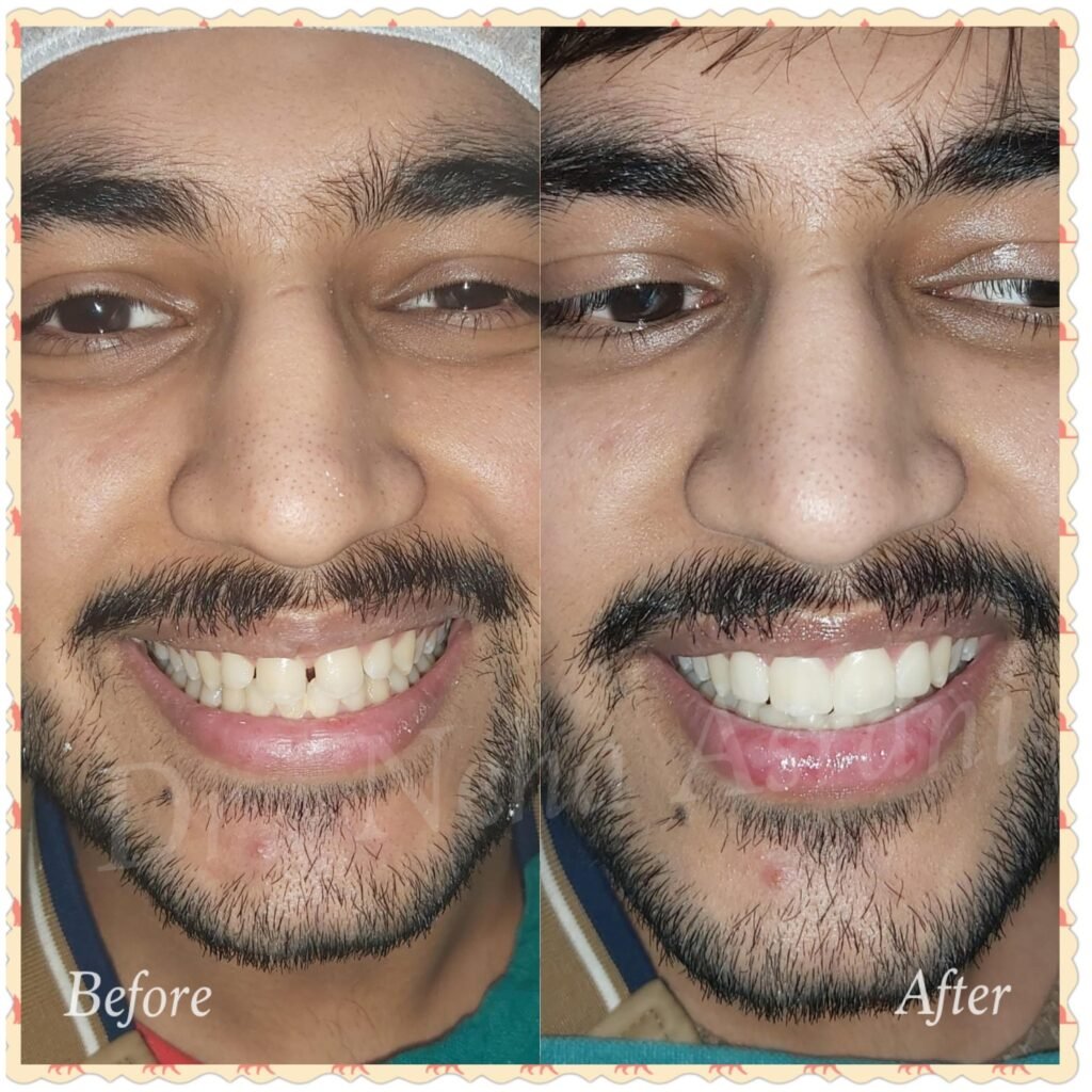 Before and after: Smile makeover with veneers