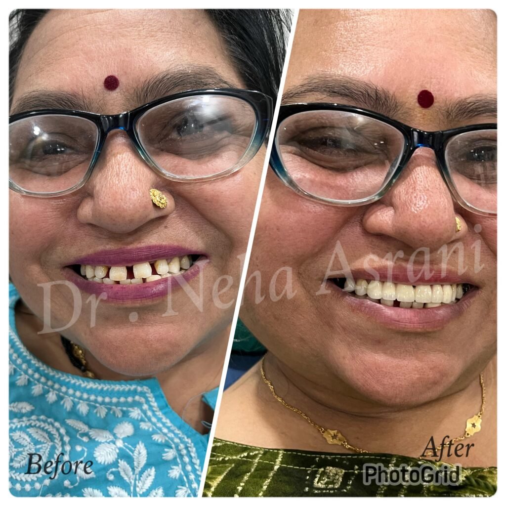 Before and after: Cosmetic smile correction