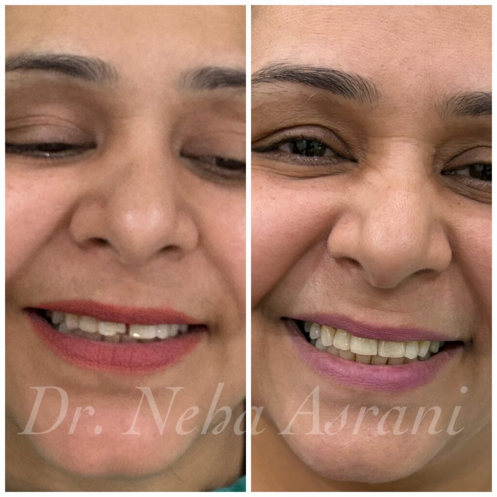 Before and after: Chipped teeth restoration