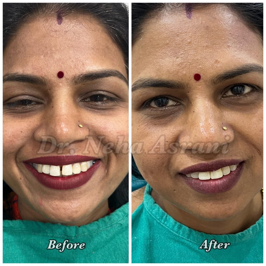 Before and after: Complete smile transformation