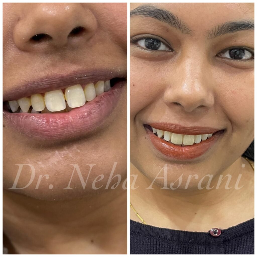 Before and after: Gap closure with bonding