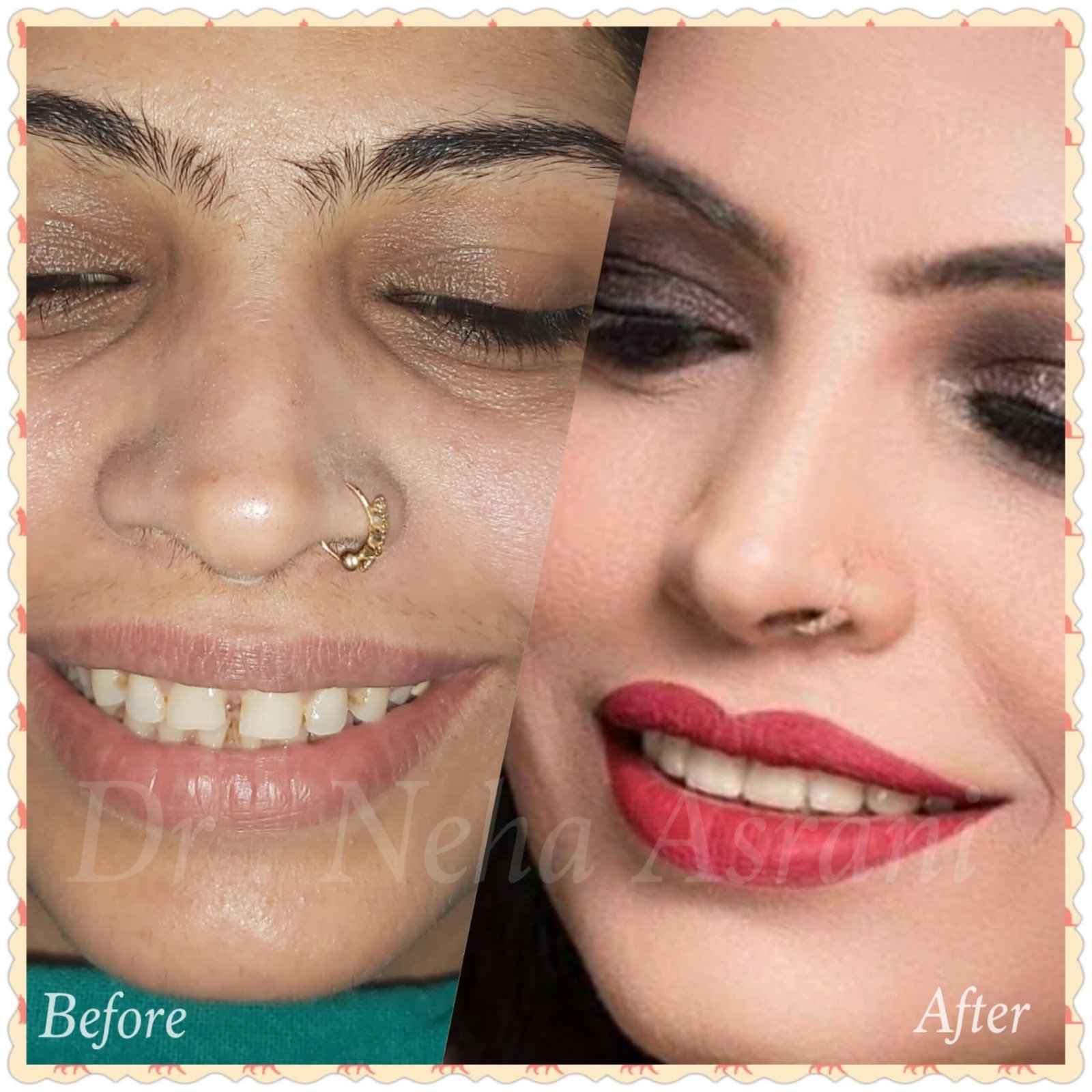 Before and after: Cosmetic smile correction