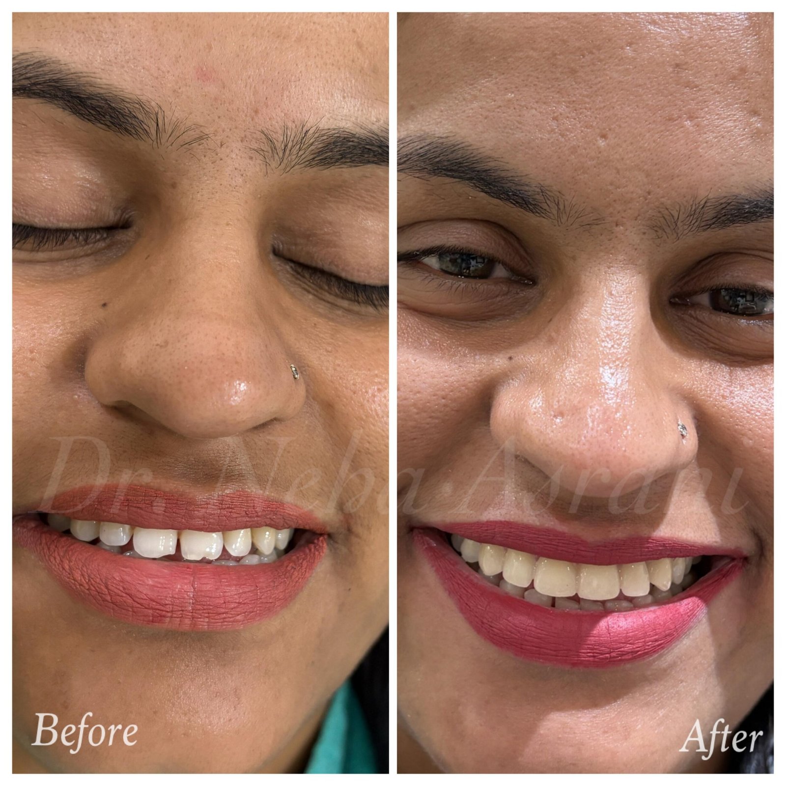 Before and after: Bridal smile makeover