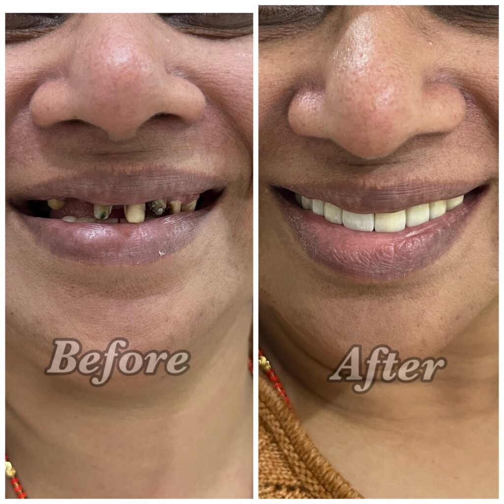 Before and after: Full mouth rehabilitation with crowns