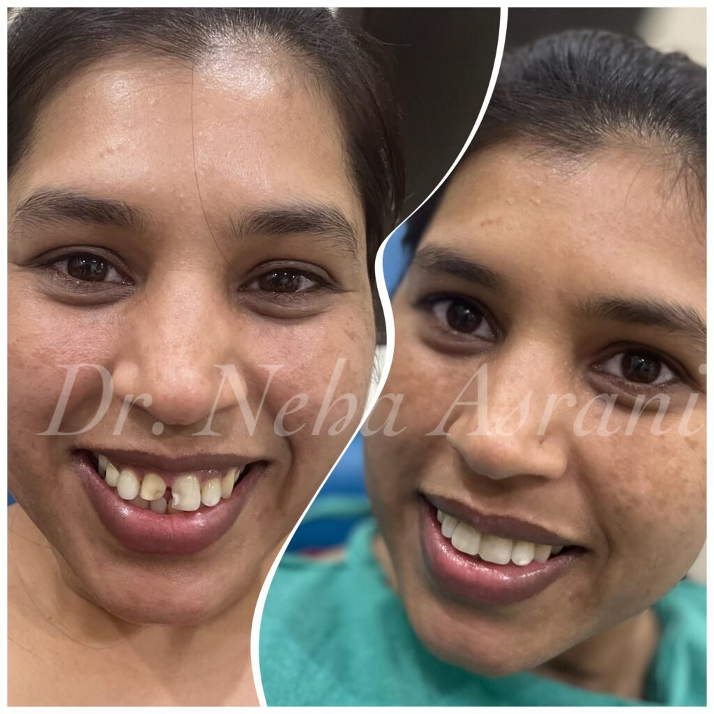 Before and after: Missing teeth replacement