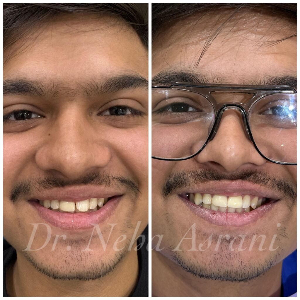 Before and after: Smile makeover with veneers