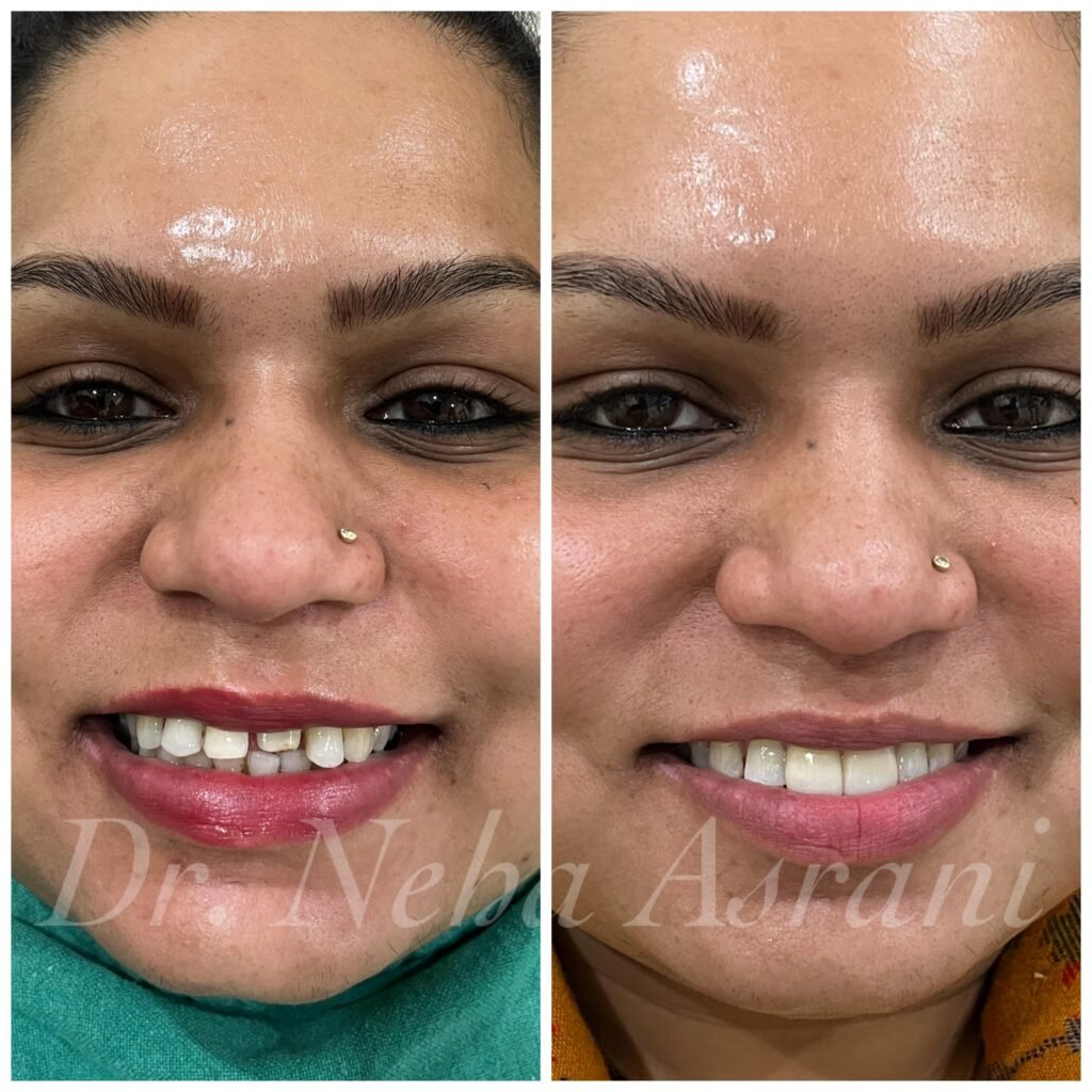 Before and after: Gap closure and reshaping