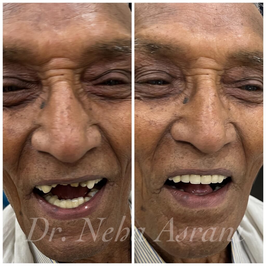 Before and after: Full mouth rehabilitation