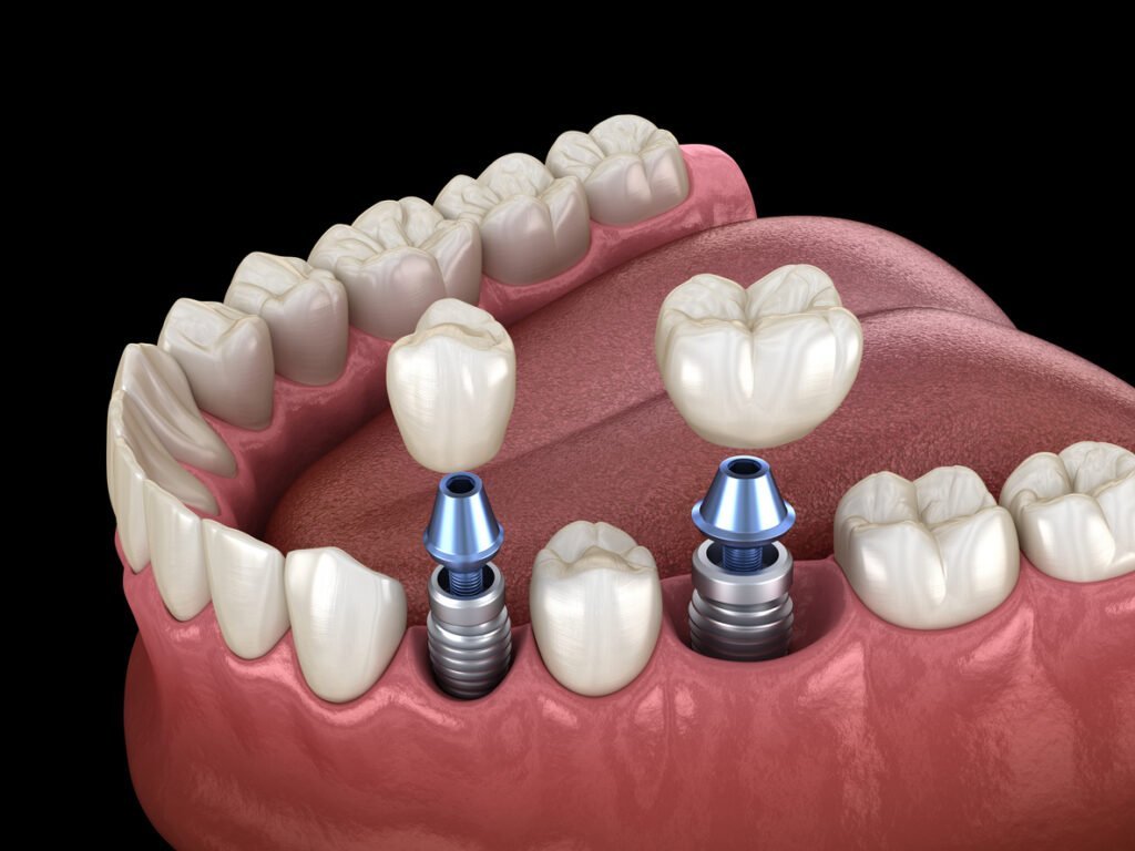 Dental Implants at Smileography, Jabalpur
