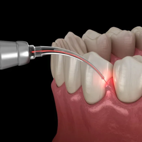 Gum Treatment at Smileography, Jabalpur