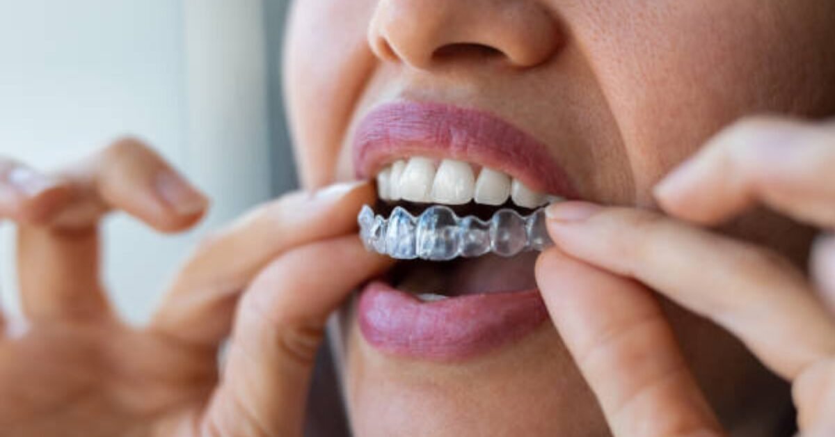 Orthodontics & Clear Aligners at Smileography, Jabalpur