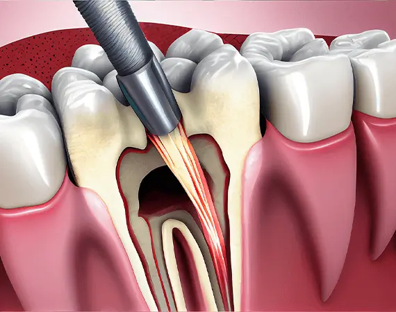 Root Canal Treatment at Smileography, Jabalpur