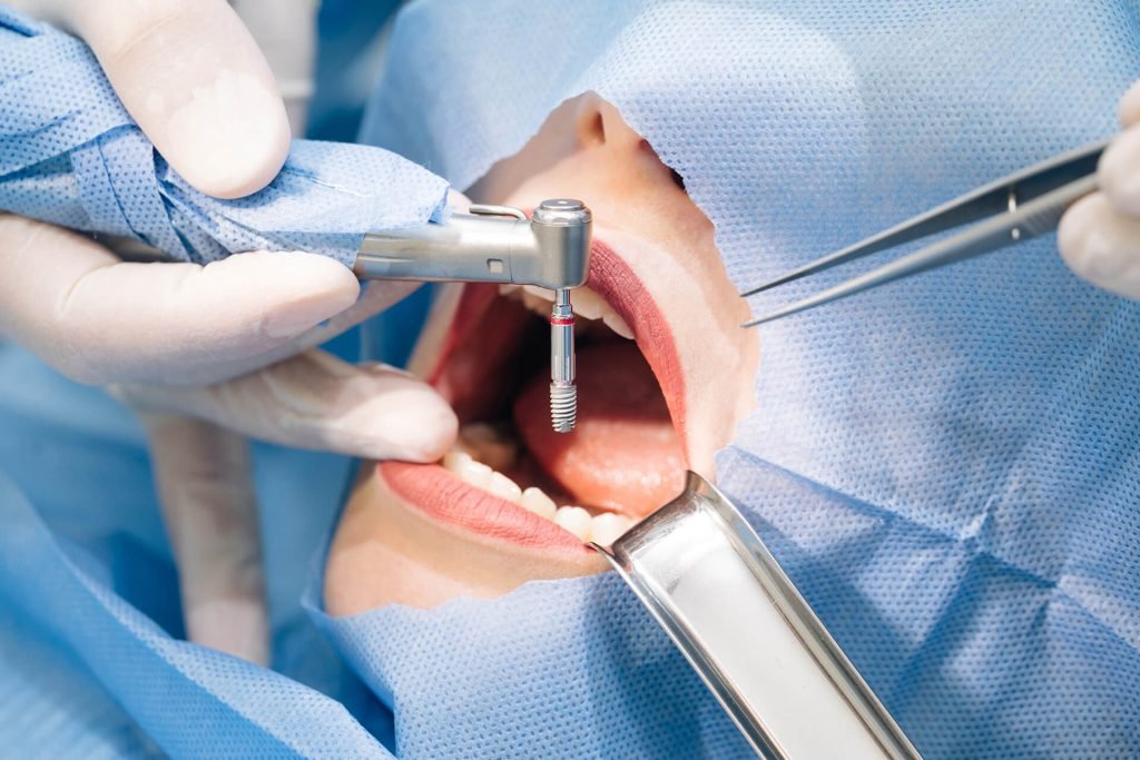 Surgical Dentistry at Smileography, Jabalpur